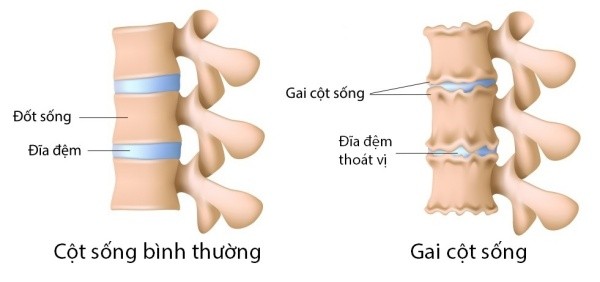 cot-song-binh-thuong-va-gai-cot-song-1727454028.jpg